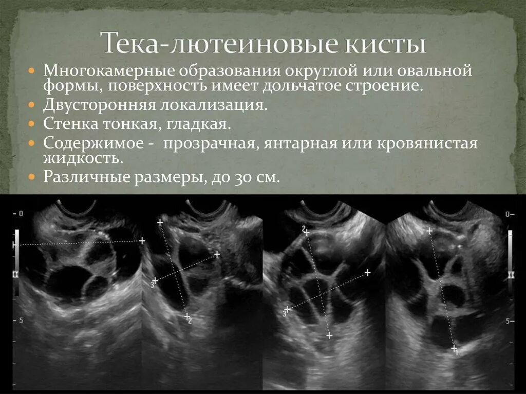 Текалютеиновая киста яичника УЗИ. Текалютеиновые кисты яичников на УЗИ. Кистозное образование.