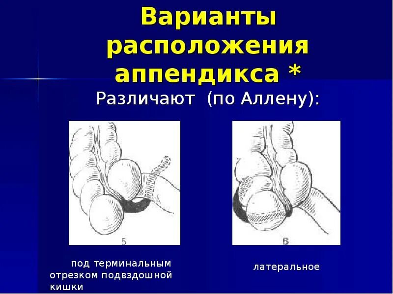 Строение аппендикса. Расположение аппендикса. Функции червеобразного отростка. Расположение червеобразного отростка.