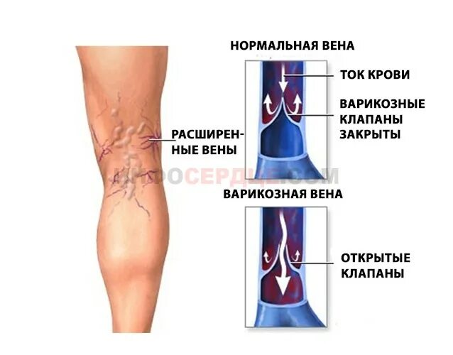 Причина плохих вен. Хроническая венозная недостаточность (хвн). Тромбоз мышечных вен голени. Облитерирующий атеросклероз гангрена. Флебит тромбофлебит нижних.