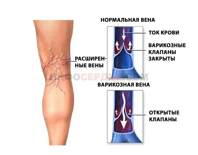 Строение вен нижних конечностей клапаны. Варикозное расширение вен нижних конечностей венотоники. Строение вен нижних конечностей варикоз. Венозные клапаны в сосудах нижних конечностей. Что значат вены на ногах