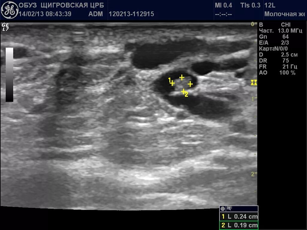 Внутрипротоковое образование молочной железы. Внутрипротоковая папиллома молочной железы дуктография. Внутрипротоковая папиллома молочной железы на узи. Внутрипротоковая карцинома молочной железы на узи. Папиллома в протоках молочных желез.