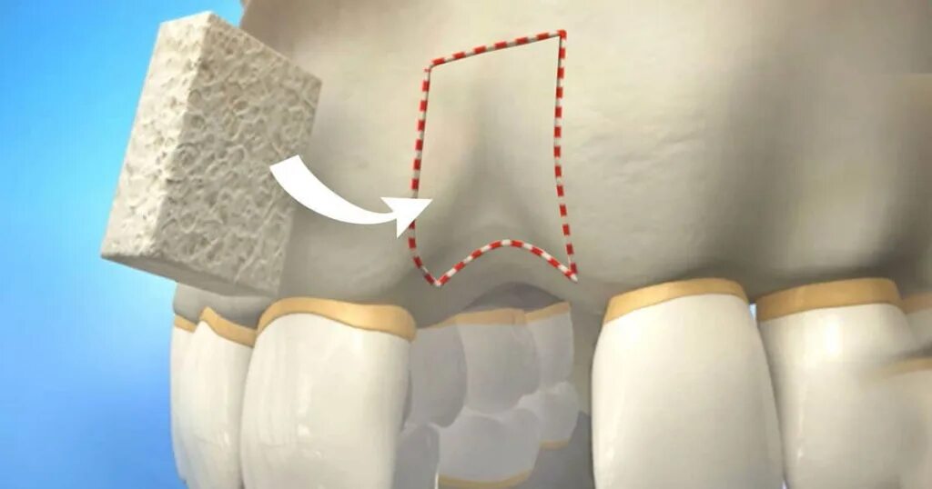 Пересадка кости. Остеопластика костной ткани челюстей. Костная пластика аугментация. Синус-лифтинг костная пластика. Костная пластика альвеолярного отростка.