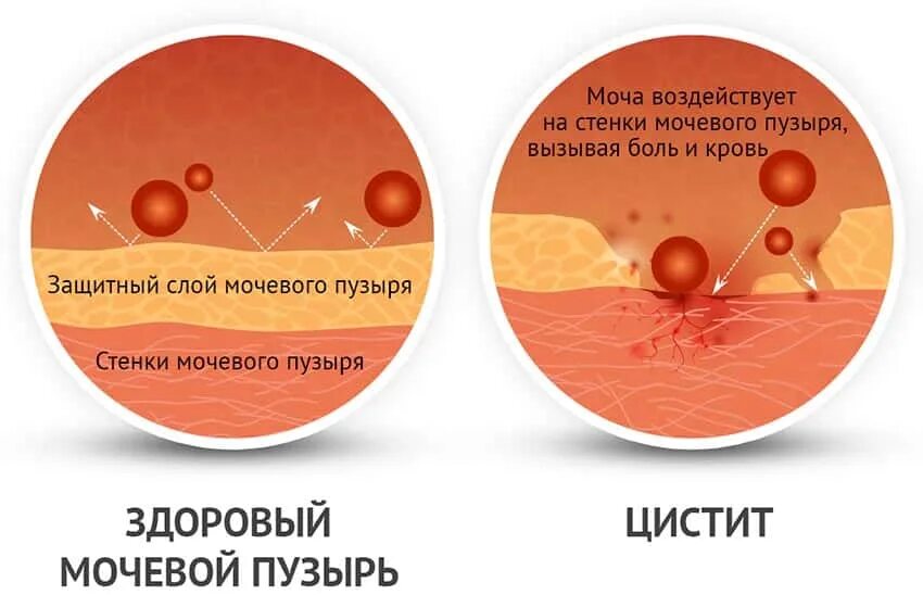 Женский цистит. Цистит симптомы меры профилактики