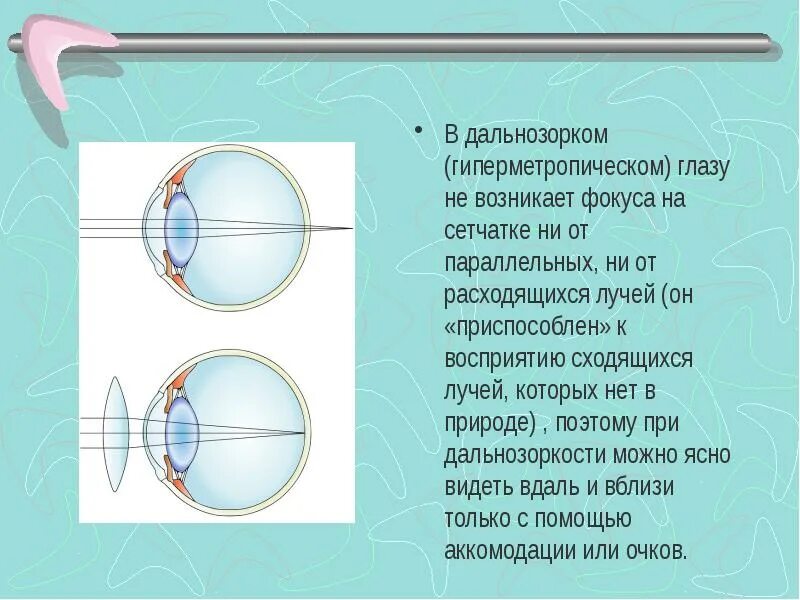 Аккомодация вблизи. Ход лучей в гиперметропическом глазу. гиперметропическая рефракция. слепое пятно аккомодация. лучи в дальнозорком глазу.