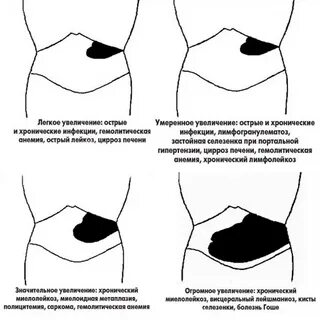 Увеличенная селезенка причины у взрослого симптомы