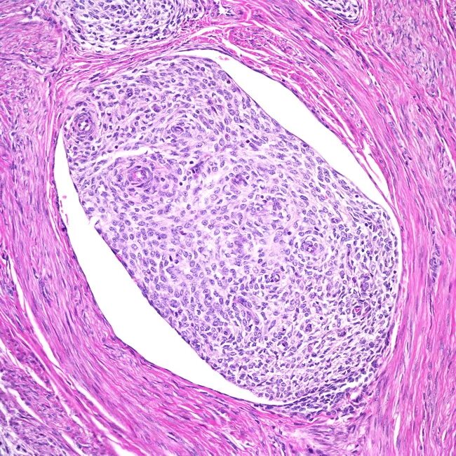 Стромальная саркома. Фибросаркома гистология. Монофазная синовиальная саркома гистология. Цистаденокарцинома серозная папиллярная гистология. Фибромиома матки гистология.