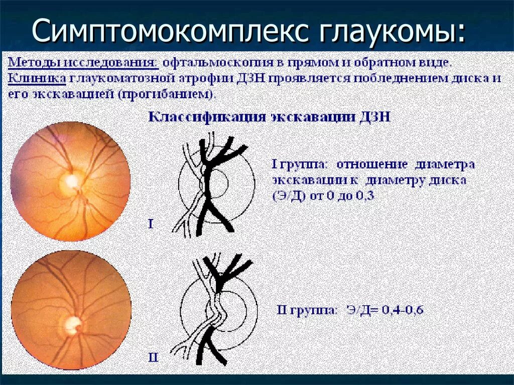 Размеры зрительных нервов. Глаукома диск зрительного нерва. Показатель экскавации диска зрительного нерва. Экскавация ДЗН. Глаукомная экскавация зрительного нерва.