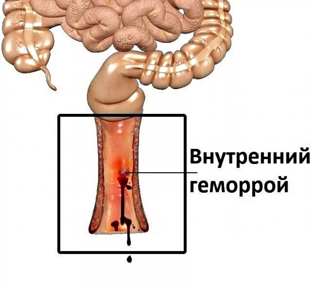 Лечение трещин кишки. Внутренний геморрой первой стадии. Внутренний геморрой прямой кишки. Внутренние геморрой узлы геморрой.