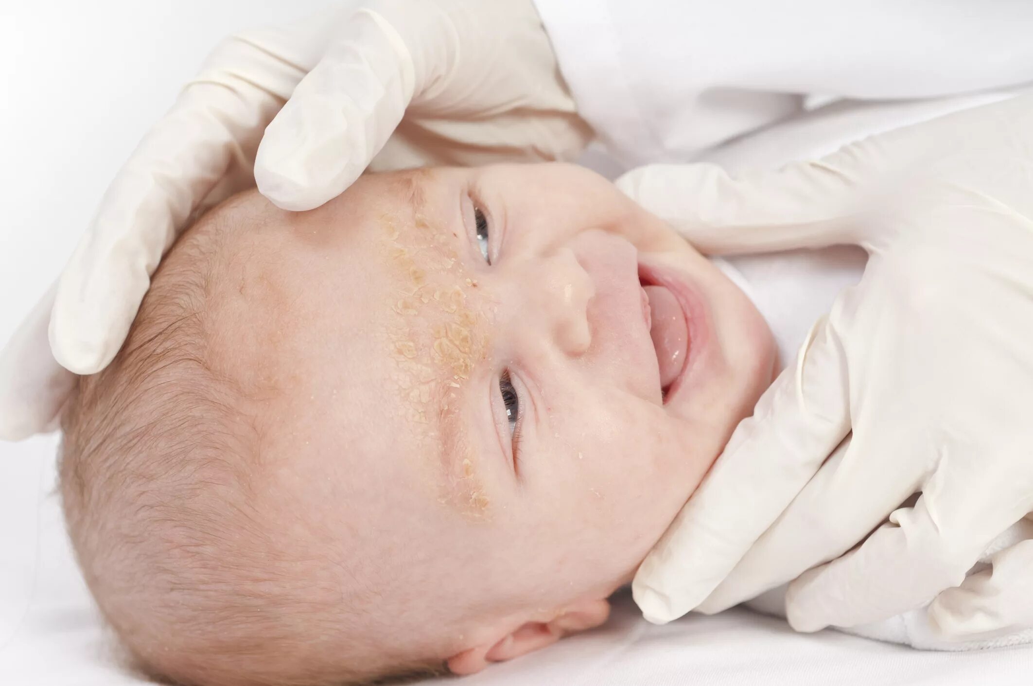 Детский кожный. Экссудативно-катаральный диатез у новорожденного. Везикулопустулез новорожденного. Себорейный дерматит у новорожденного. Экссудативно катаральный диатез сыпь.