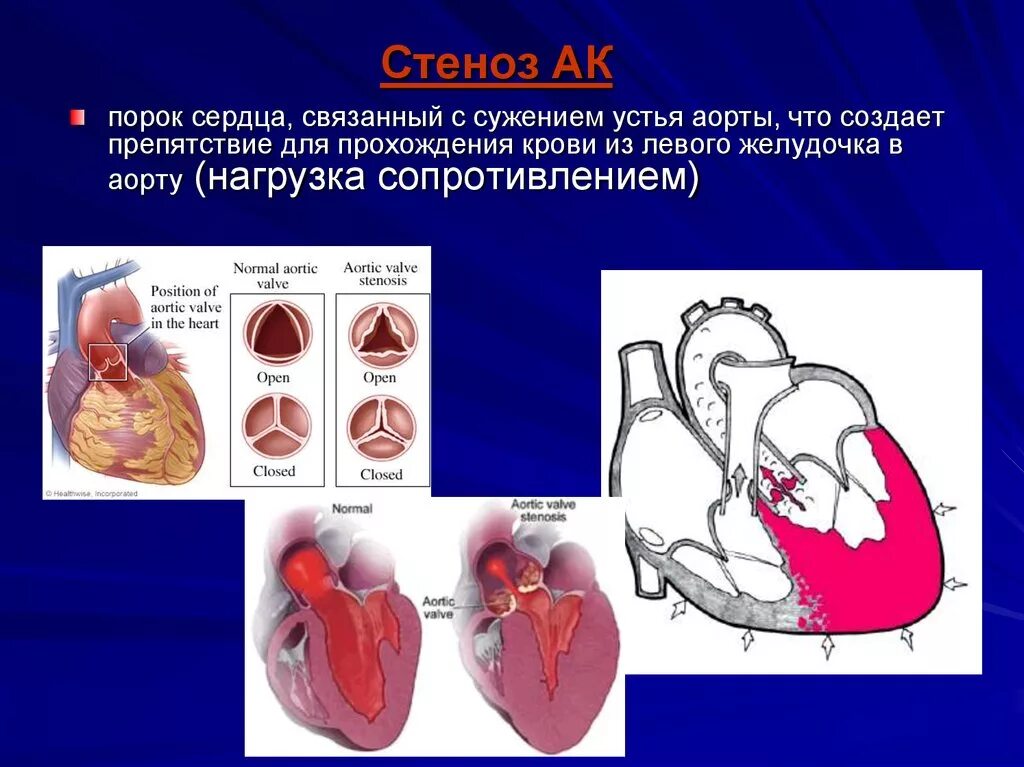 Сердечный стеноз. Аортальный стеноз патофизиология. Доклад на тему пороки сердца.