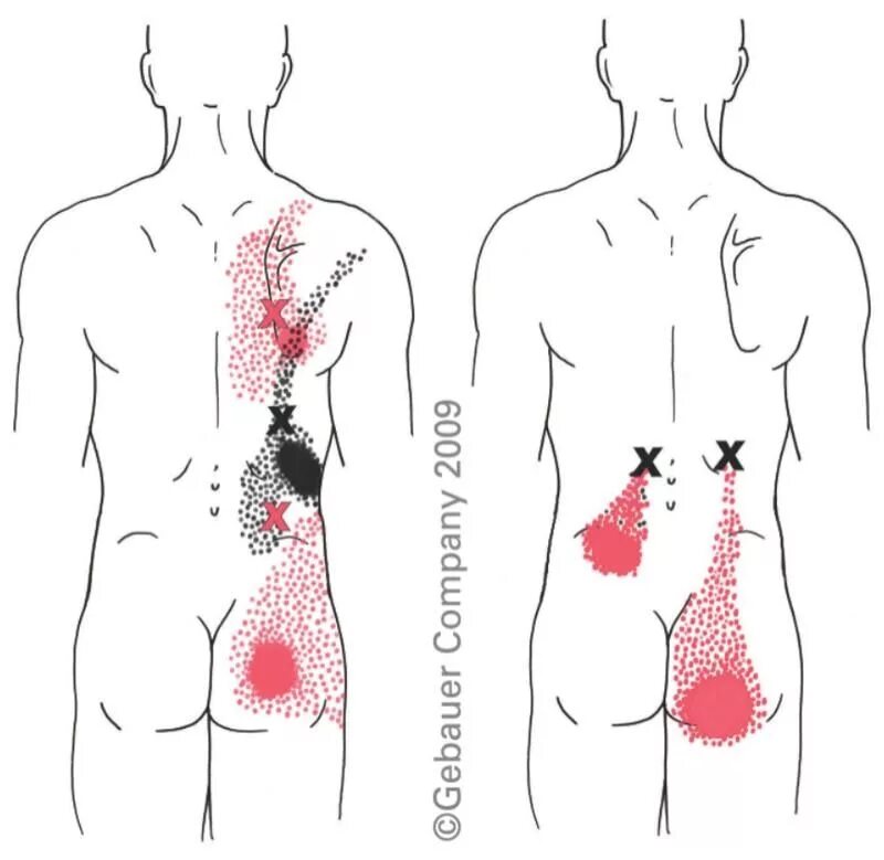 Точки на пояснице. Мышцы спины человека триггерные точки. Карта триггерных точек спины с отраженными болями. Карта триггерных точек с отраженными болями. Триггерные зоны при болях в крестце.