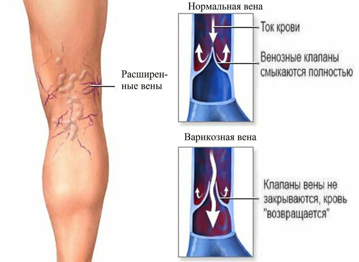 Варикозное заболевания расширение вен нижних конечностей. Варикозное расширение вен патанатомия. Боли при варикозном расширении