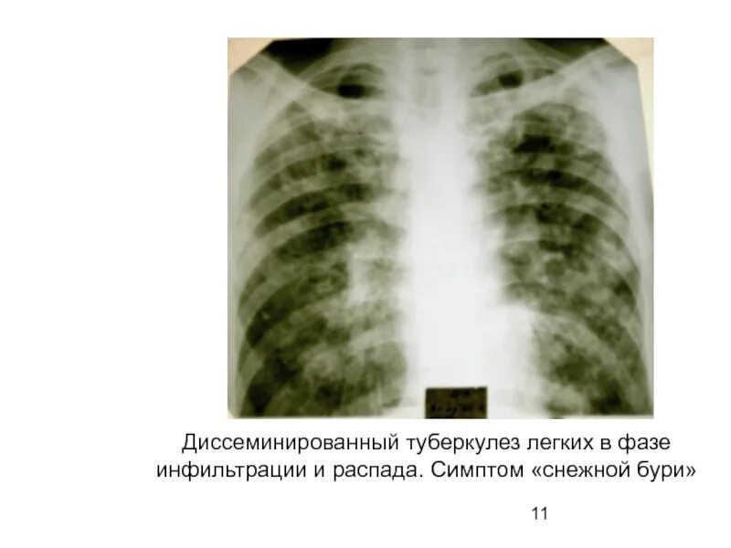 Подострый диссиминированный туберкулёз рентген. Диссеминированный инфильтративный туберкулез. Острый диссеминированный туберкулез рентген. Подострый диссеминированный туберкулез рентген.