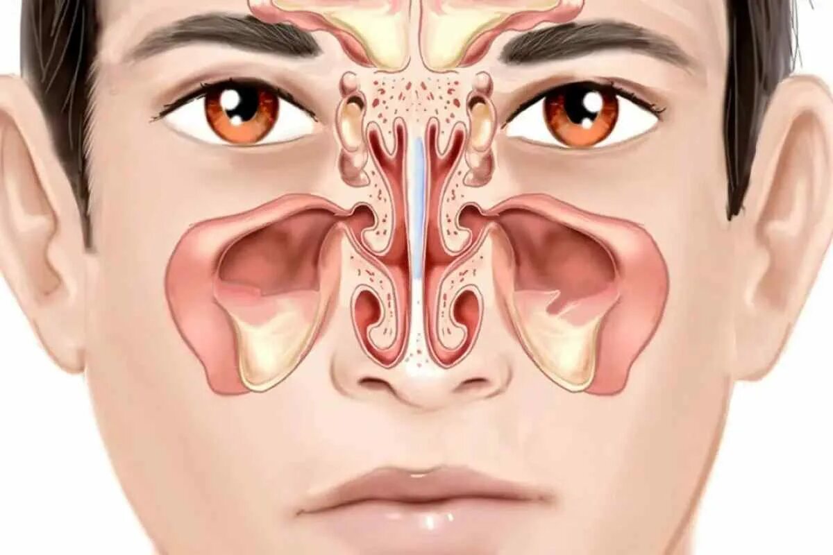 Гайморит фронтит этмоидит. Гайморовых пазух слизистой оболочки