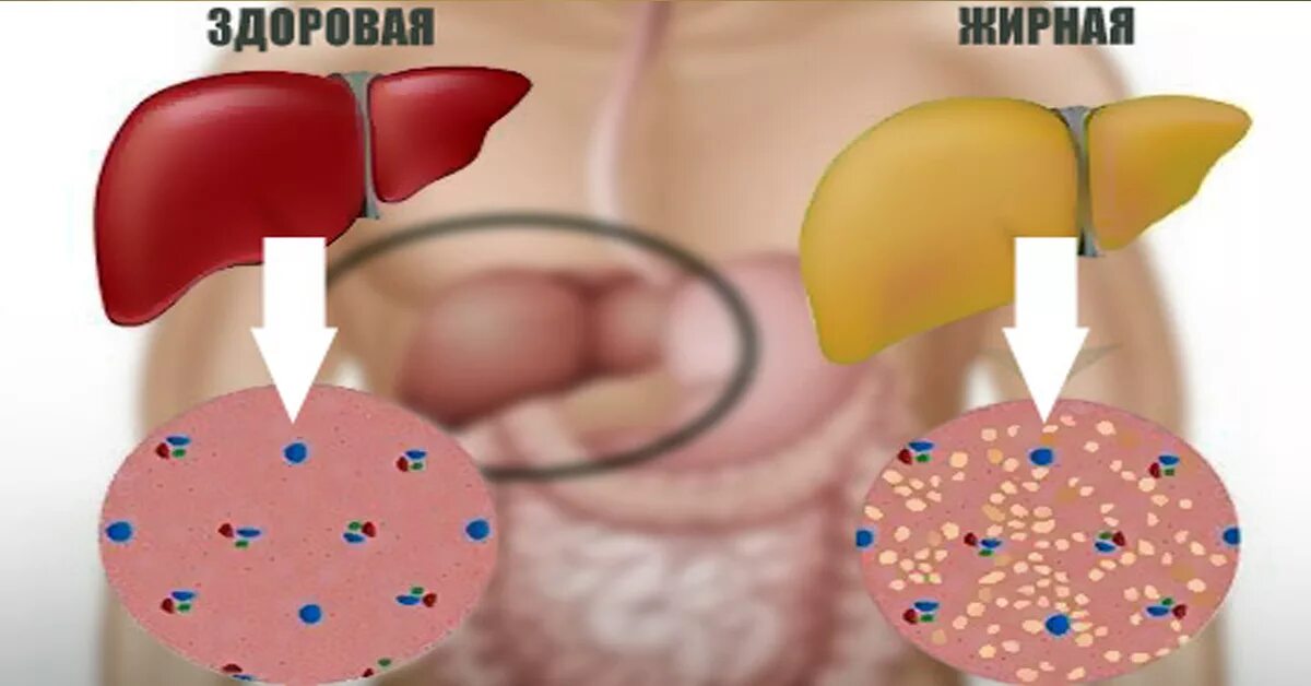 Печень под жиром. Жировая болезнь печени. Накопление жира в печени.