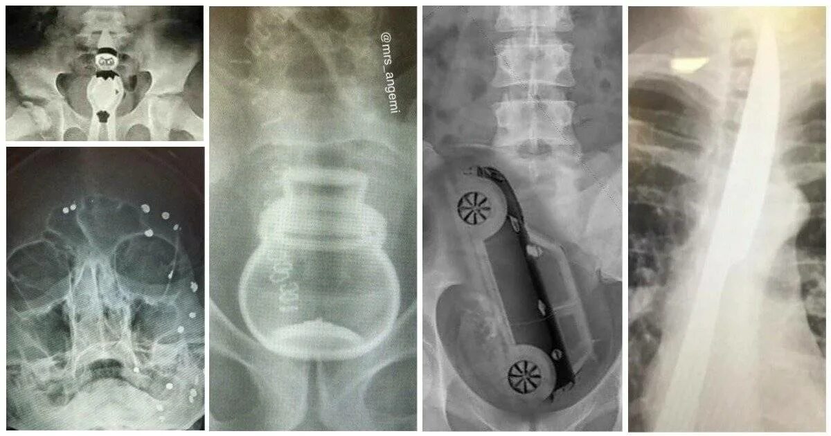 Проглотил через сколько выйдет. Рентгеновские снимки. Инородные предметы на рентгене. Инородные объекты на рентгенограмме.