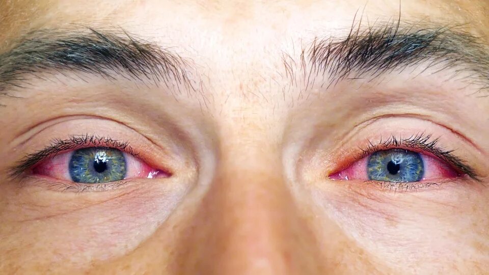 Глазное давление боль. Сосуды склер инъецированы. Кровоизлияние в склеру глаза.