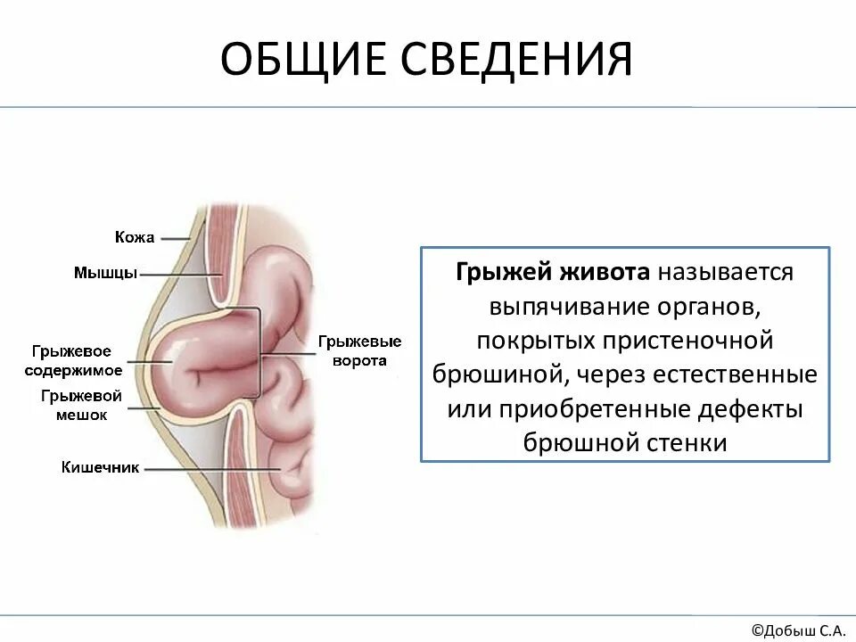 Симптомы грыжи живота у женщин слева