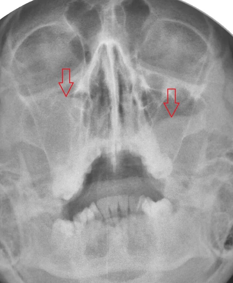 Киста гайморовой пазухи на рентгене. Верхнечелюстной синусит рентген. Рентген гайморит фронтит этмоидит. Пристеночный отек слизистой