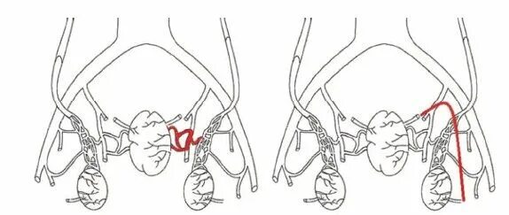 Артерии простаты. Эмболизация артерий предстательной железы. Эмболизация сосудов при аденоме простаты. Варикозное расширение вен малого таза операция. Варикоз малого таз операция.