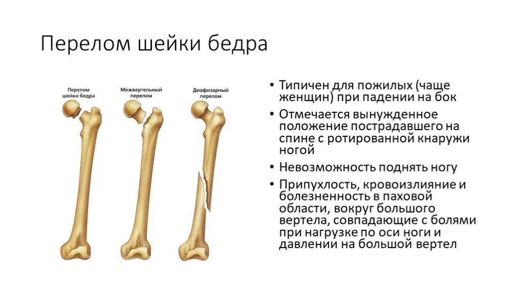 Последствия перелома шейки бедра. Чрезвертельные переломы бедренной кости классификация. Классификация переломов шеек бедренной кости. Шейка левой бедренной кости. Перелом вертельной зоны бедра.