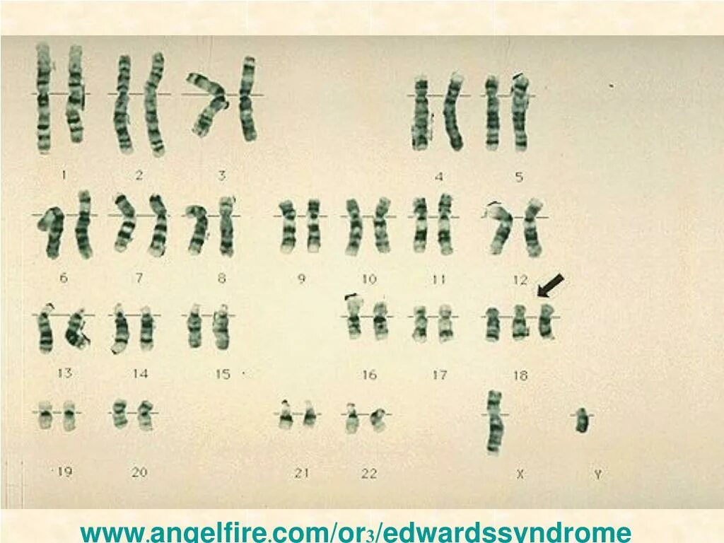 Пересадка хромосом. Трисомия по 18 хромосоме кариотип. Трисомия по 18 хромосоме синдром Эдвардса. Синдром Эдвардса кариотип. Транслокация кариотип.