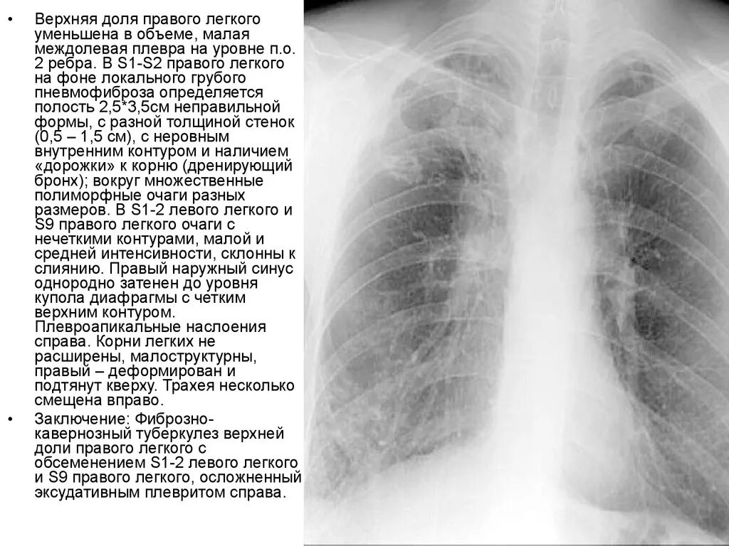 Что означает фиброзное изменение. Посттуберкулезный пневмофиброз. Легочный фиброз на рентгене. Линейный пневмофиброз рентген.