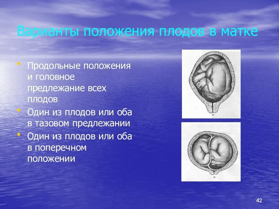 1 и 2 позиция плода. Многоплодная беременность положение плодов. Положение плода в полости матки. Продольная положение головного прилежание.