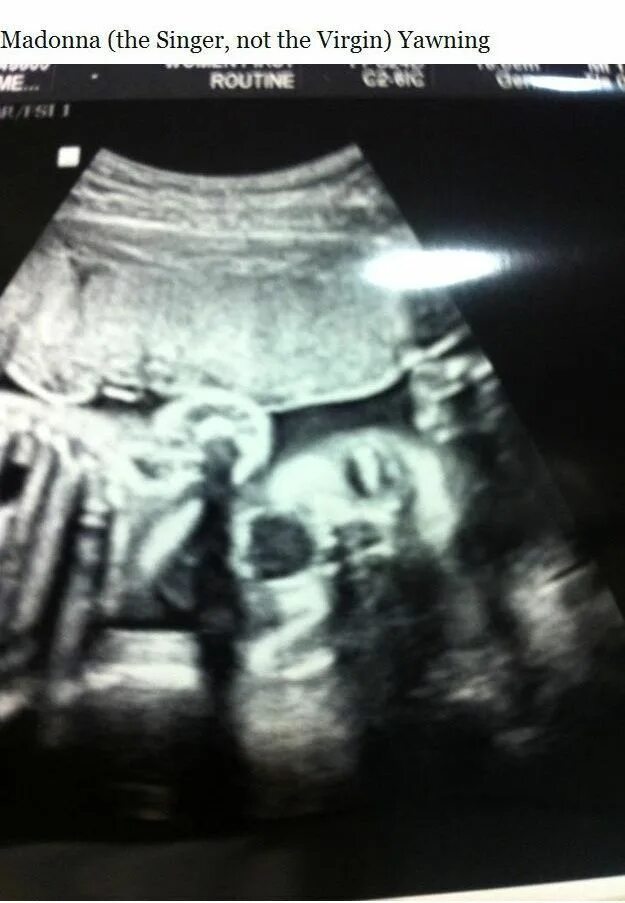 Узи ребенка. Узи после выскабливания. 6 мм. Узи матки беременность. Узи ребенка.