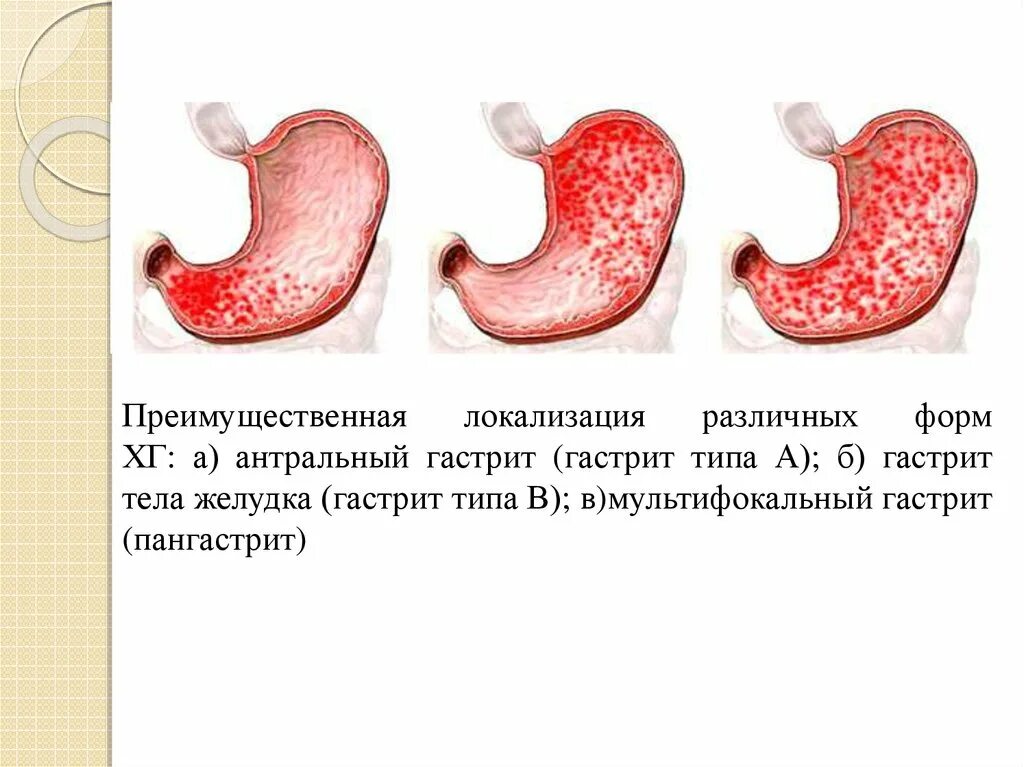 Гастрит локализация