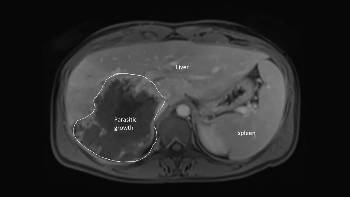 Моноцистронные паразитарные опухоли печени.