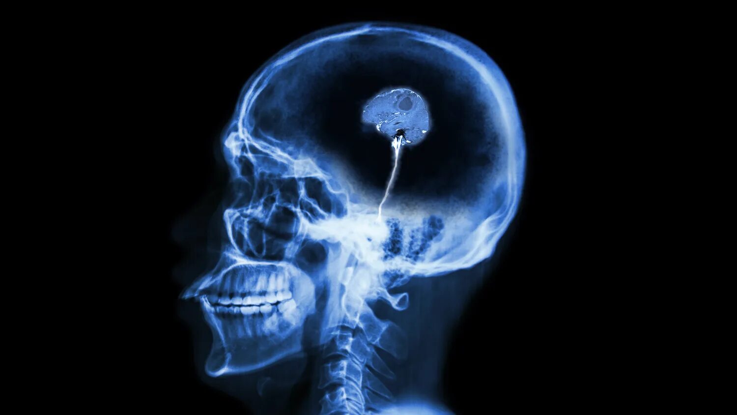 Мозг гомера симпсона рентген. Рентген маленького мозга. Рентген головы гомера симпсона. Череп 26. Череп без мозгов.