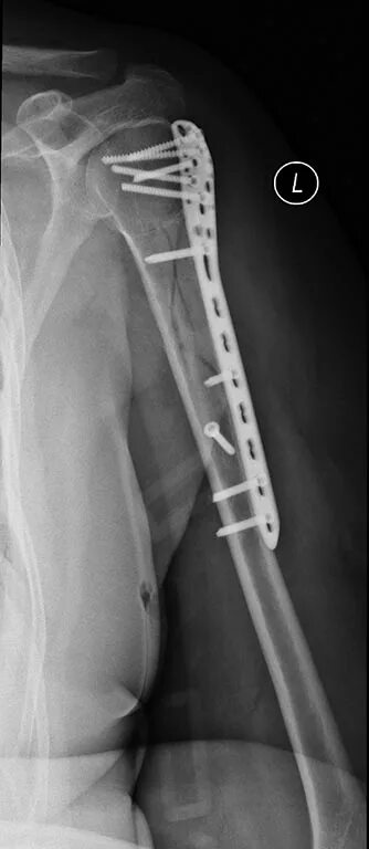остеосинтез перелома плеча. остеосинтез перелома проксимального отдела плеча. остеосинтез перелома плеча. перелом хирургической шейки плечевой кости остеосинтез. перелом диафиза плечевой кости остеосинтез.