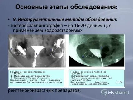 Лечение маточных труб
