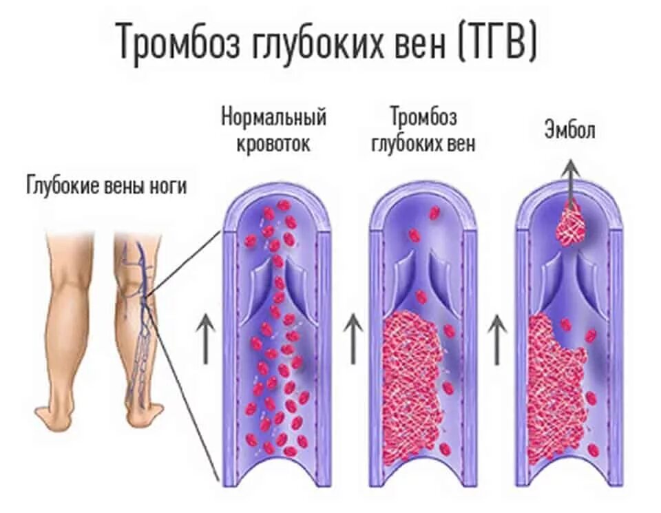 Нормальному кровообращению. Тромбоэмболия глубоких вен нижних конечностей. Тромбоз глубоких вен конечностей. Тромбофлебит глубоких вен.