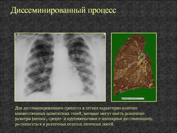 Легкая форма поражения легких. Синдром диффузной диссеминации рентген. Диссеминированный туберкулёз лёгких рентген. Диссеминированный процесс в легких рентген. Диссеминированные заболевания легких рентген.