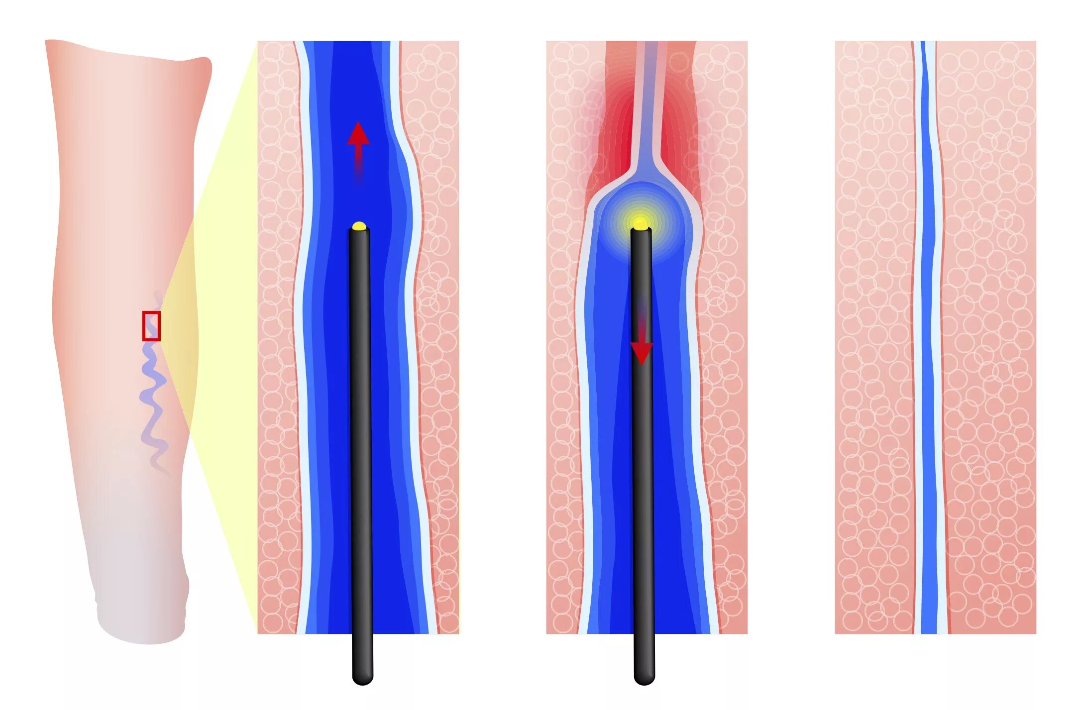 Радиочастотная облитерация (абляция) вен. Радиочастотная абляция вен нижних конечностей. Склеротерапия варикоз. Абляция пищевода