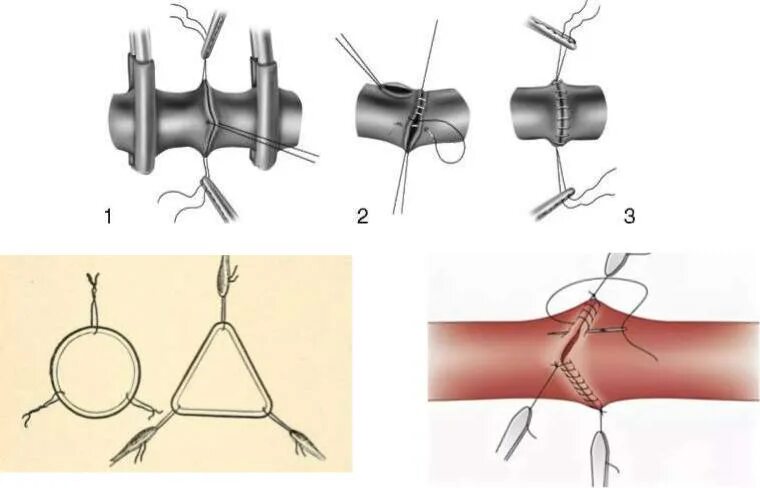 Алексис Каррель сосудистый шов. Техника наложения шва по Каррелю. Техника наложения сосудистого шва.