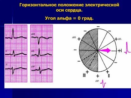 Вертикальное положение сердца у ребенка