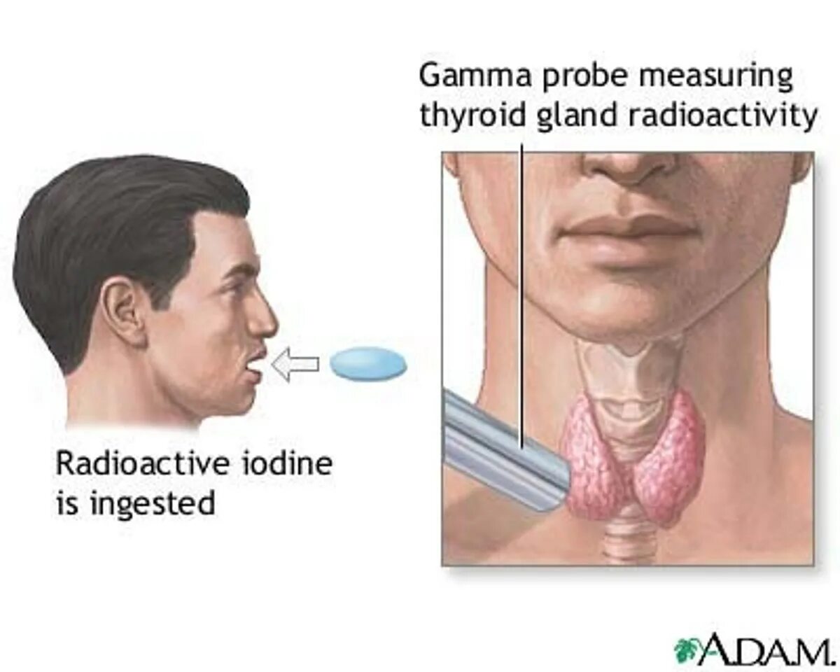 Радиоактивный изотоп йода. Терапия радиоактивным йодом щитовидной железы. Йодотерапия щитовидной железы. Радиоактивный йод щитовидная железа. Радиоактивный изотоп в щитовидной железы.