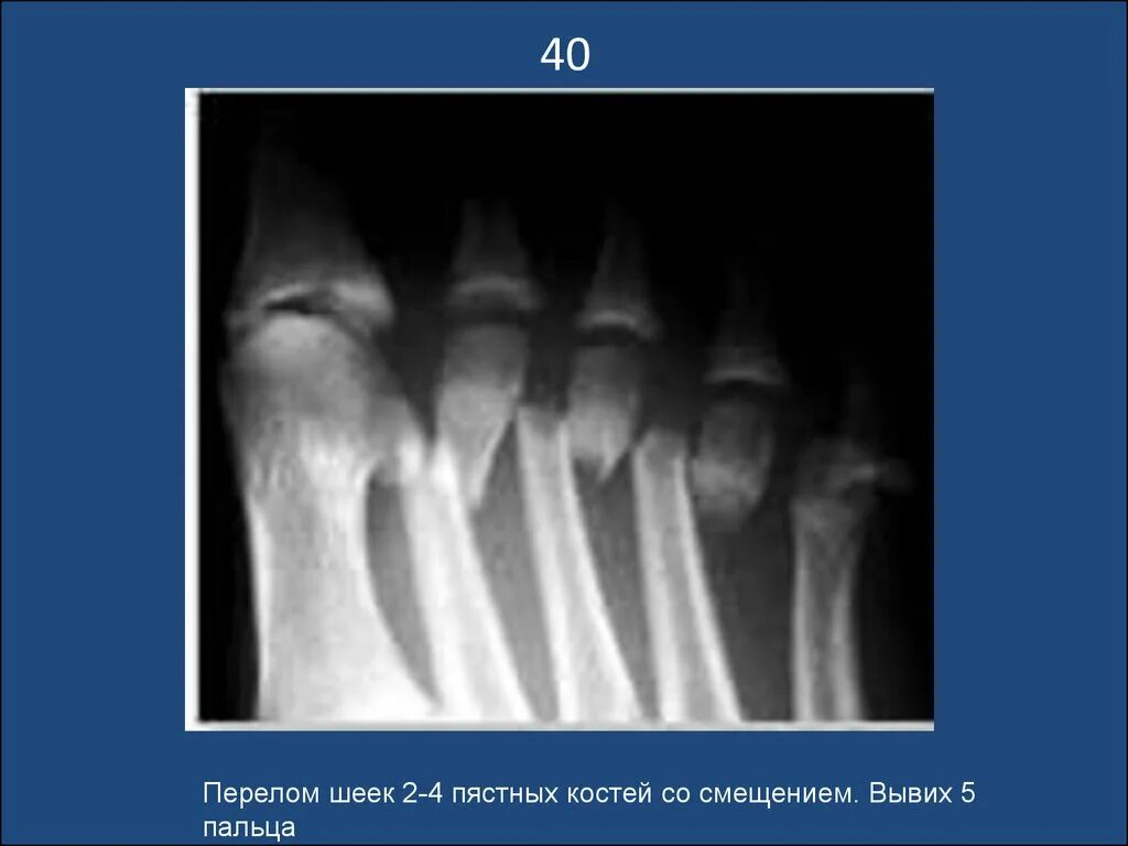 Пястная кость смещение