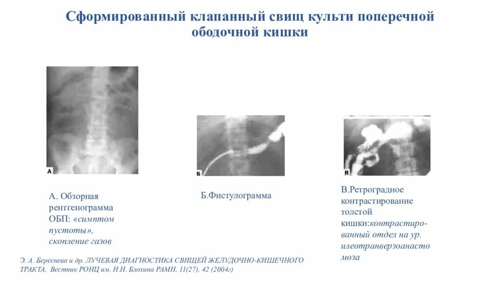 Хирургические заболевания прямой кишки. Бронхоплевральный свищ рентген. Толстокишечный свищ рентген. Свищи желудочно-кишечного тракта.