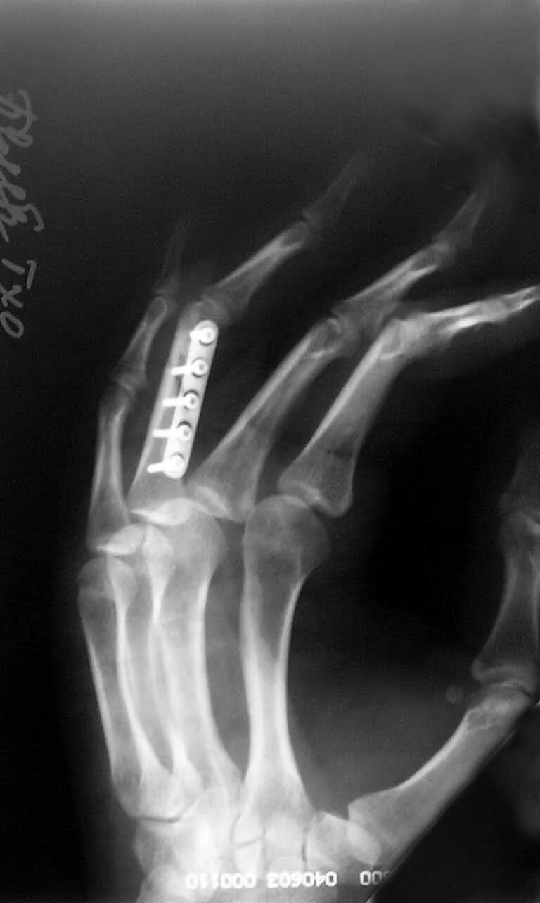 Трещина фаланги. Перелом фаланги мизинца рентгенограмма. Оскольчатый перелом основной фаланги 1 пальца. Краевой перелом проксимальной фаланги 4 пальца левой кисти. Оскольчатый перелом фаланги пальца руки.