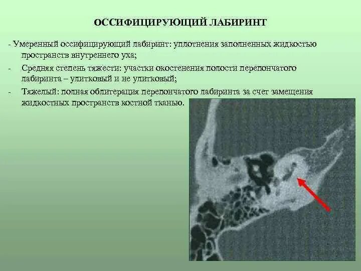 Воспаление внутреннего уха лабиринтит. Воспалительные заболевания внутреннего уха (лабиринтиты).. Лабиринтит на кт. Внутренний отит (лабиринтит).