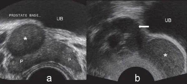 Узел в простате. Трансректальное УЗИ предстательной железы. Гиперплазия предстательной железы УЗИ. Ректальный датчик для УЗИ.
