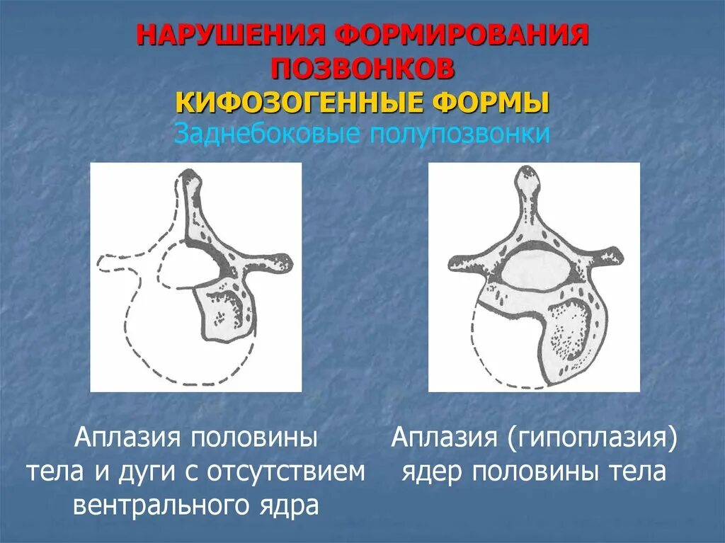 Аномалии развития позвоночника. Нарушение формирования позвонков. Аномалии развития позвонков. Недоразвитие позвонка. Аномалии развития тел позвонков.