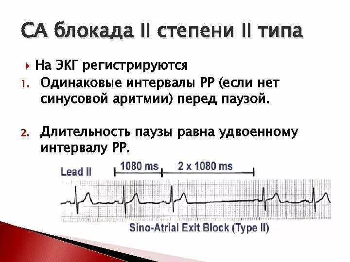 Блокада на первом. Са блокада 2 степени Мобитц 1 на ЭКГ. Синоатриальная блокада 2 степени Мобитц 1. Са блокада 2 степени 1 типа на ЭКГ. Синоаурикулярная блокада 2 степени 1 типа.