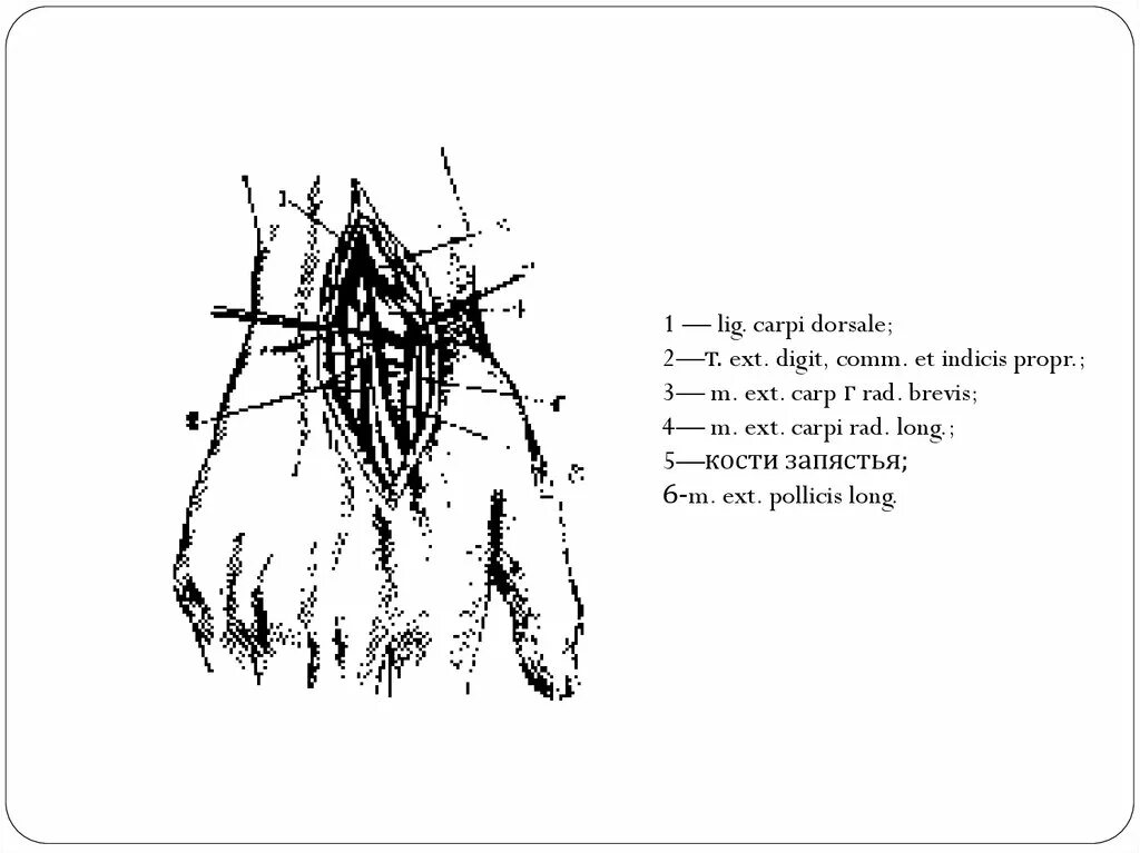 Артротомия плечевого сустава. Артротомия лучезапястного сустава по Лангенбеку. Резекция лучезапястного сустава по Лангенбеку. Артротомия лучезапястного сустава техника. Rete Carpi dorsale рисунок.