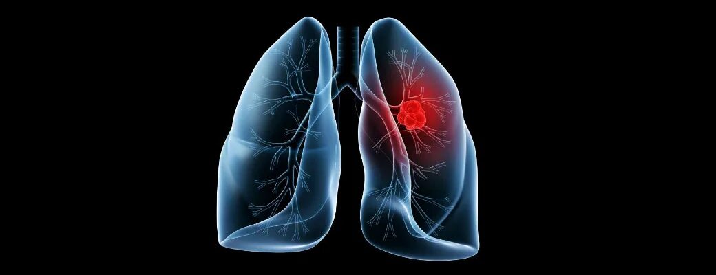 Внебольничная пневмония. Жи легких. Дыхательная система бронхиальное дерево. Жи легких. Жи легких.