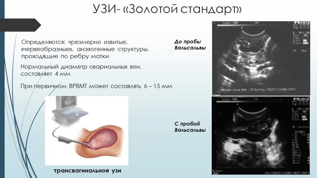 Варикоз органов таза у женщин. Расширение вен матки на УЗИ. Расширение вен малого таза по УЗИ. УЗИ органов малого таза варикозное расширение вен. Варикозное расширение вен малого таза по УЗИ.